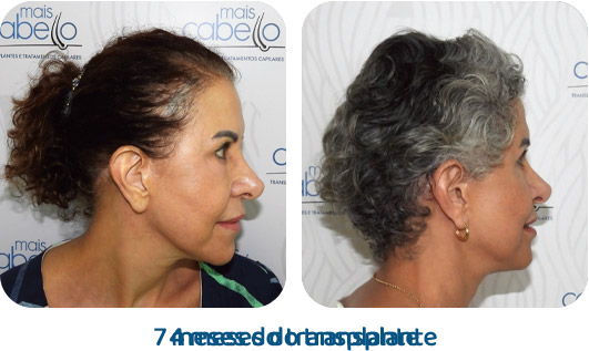 Antes e Depois - Caso Real