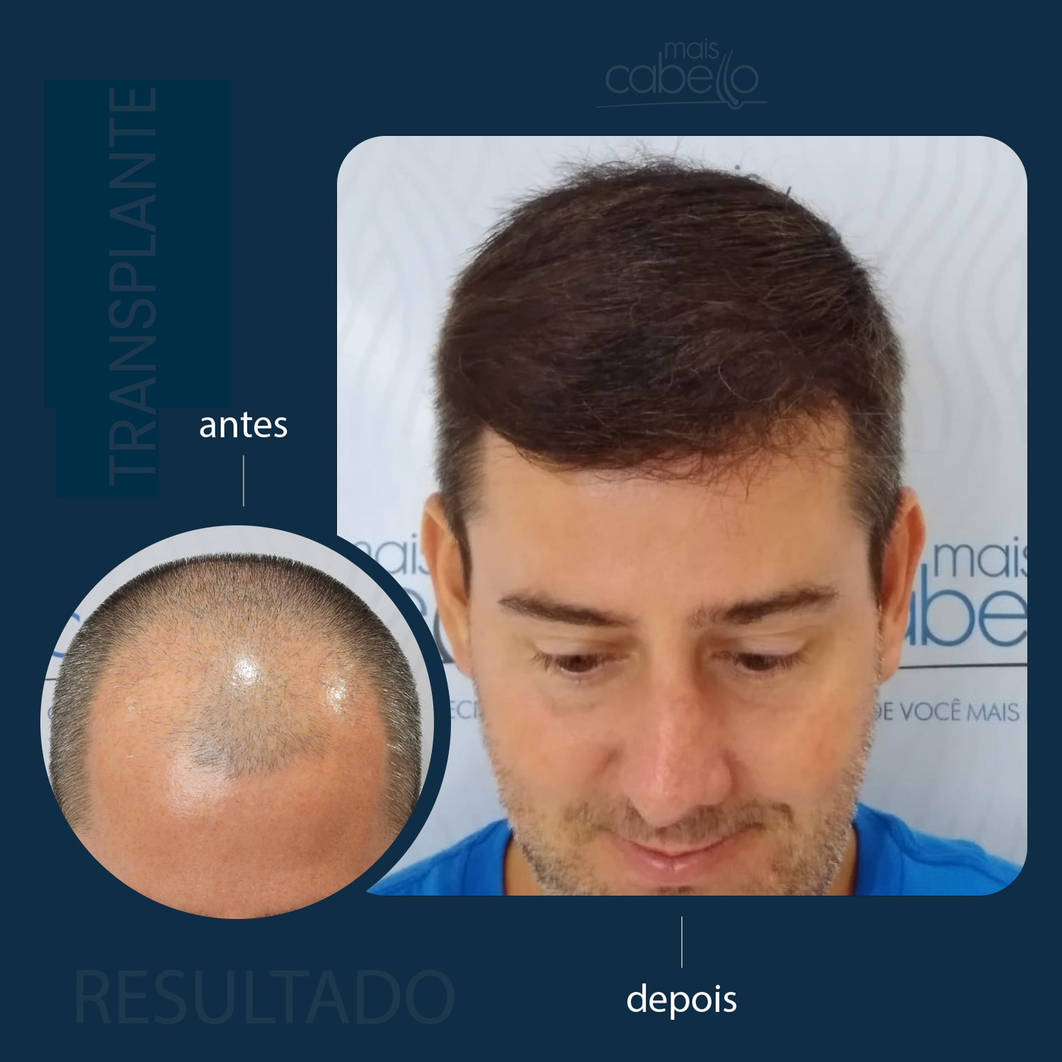 Antes e Depois - Transplante Capilar