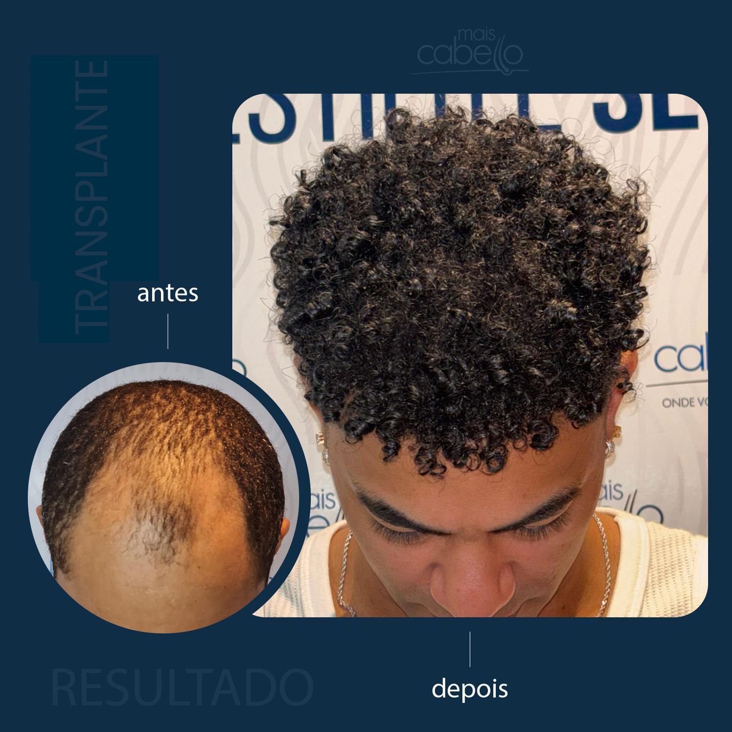 Antes e Depois - Transplante Capilar