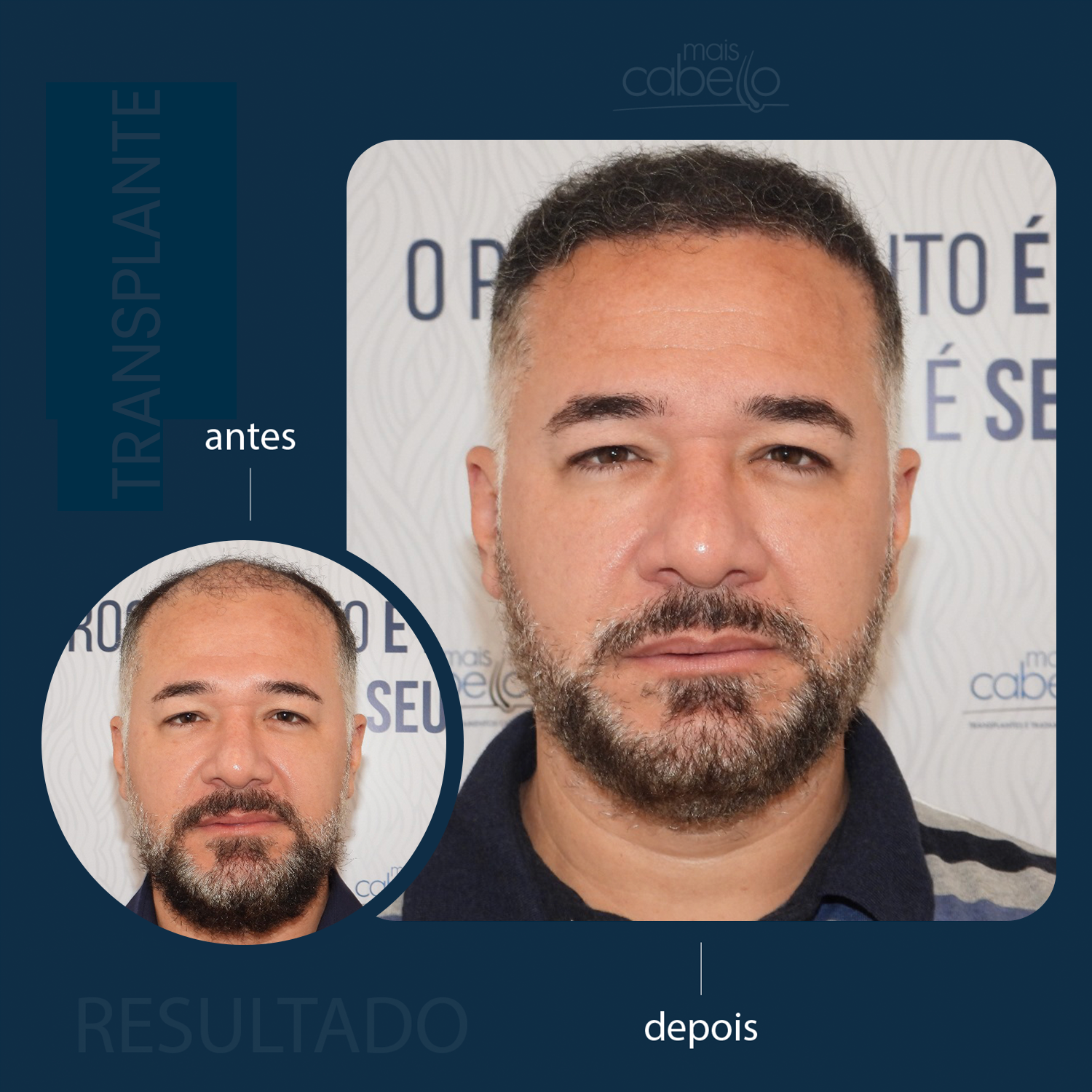 Antes e Depois - Transplante Capilar