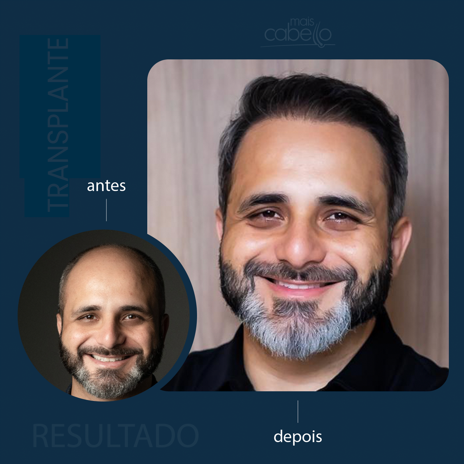 Antes e Depois - Transplante Capilar