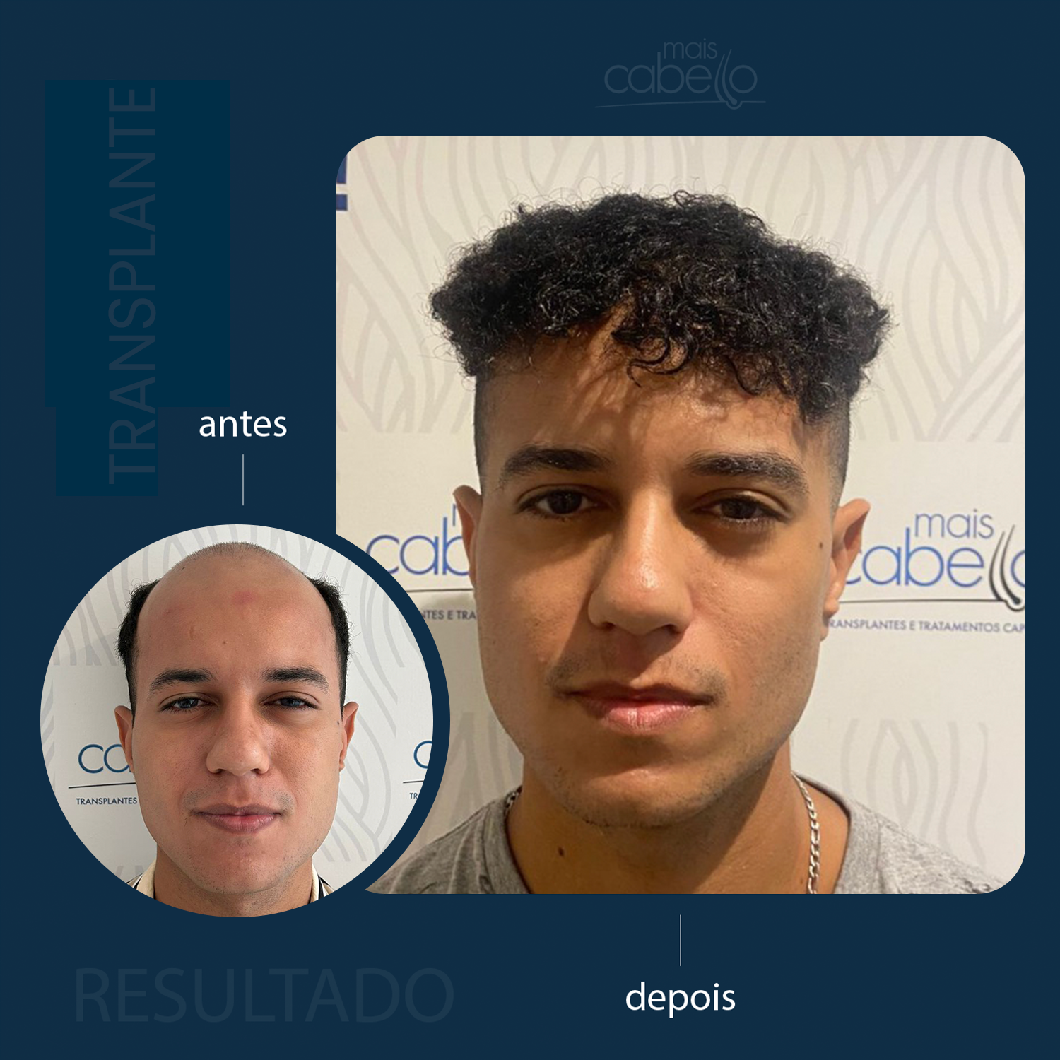 Antes e Depois - Transplante Capilar