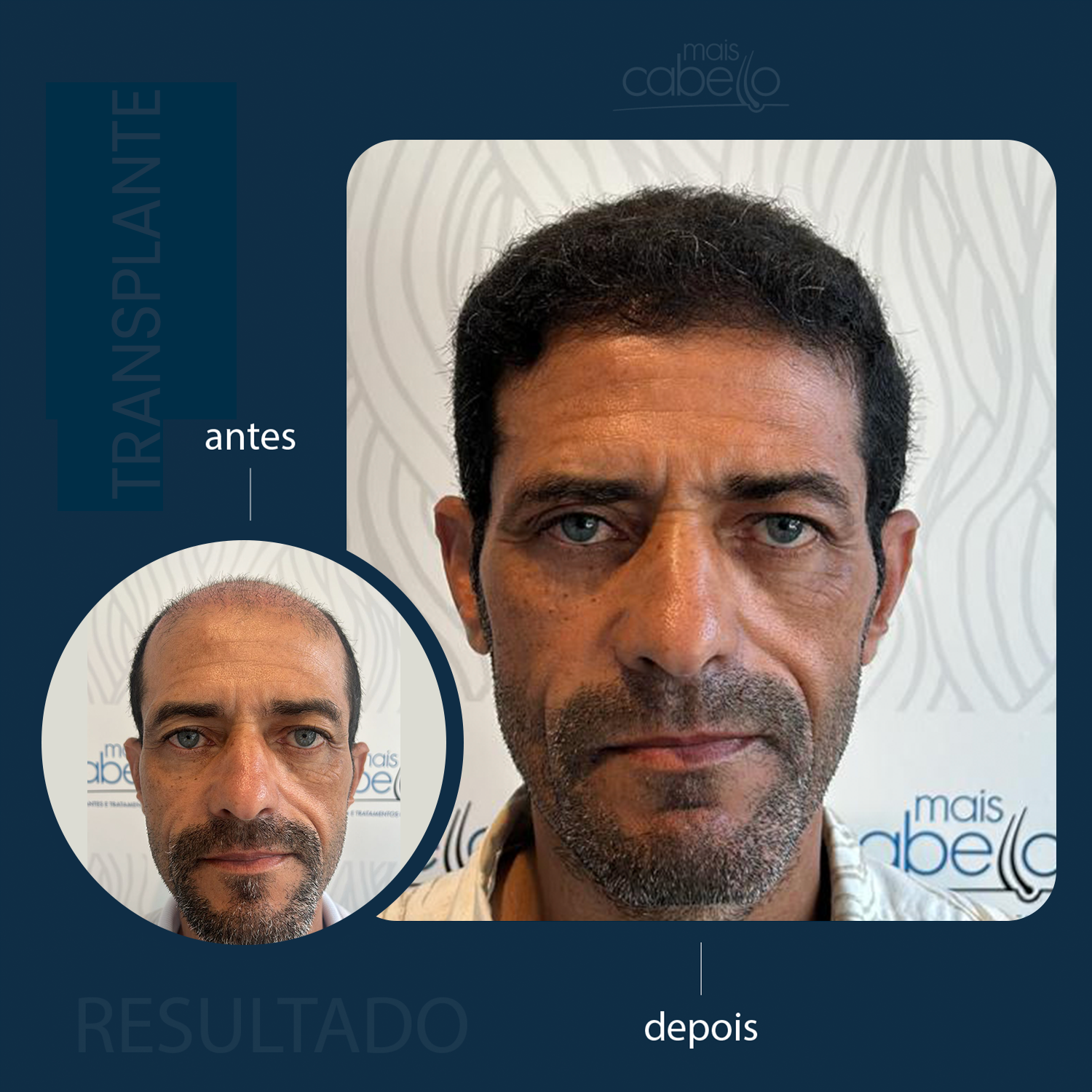 Antes e Depois - Transplante Capilar