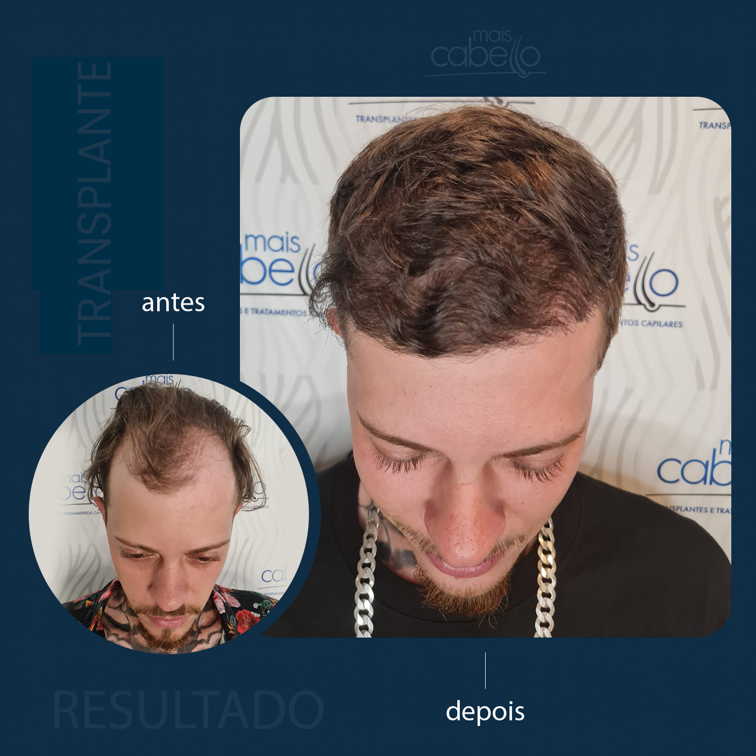 Antes e Depois - Transplante Capilar